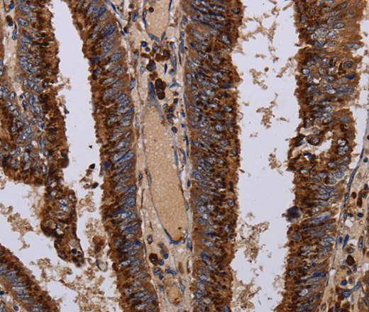 Immunohistochemistry of paraffin-embedded Human colon cancer tissue using PPP1R1B Polyclonal Antibody at dilution 1:50