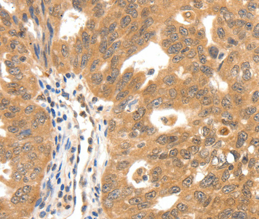 Immunohistochemistry of paraffin-embedded Human ovarian cancer tissue using SCN5A Polyclonal Antibody at dilution 1:30