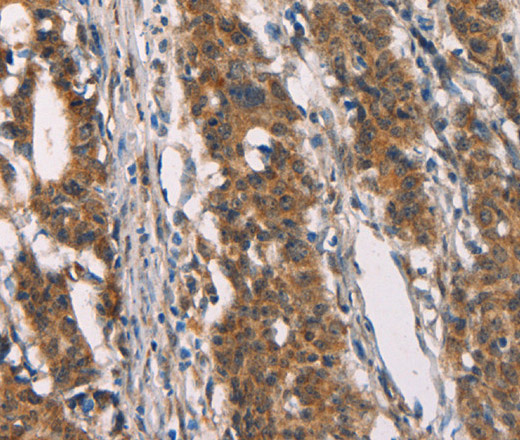 Immunohistochemistry of paraffin-embedded Human gastric cancer tissue using CD80 Polyclonal Antibody at dilution 1:50