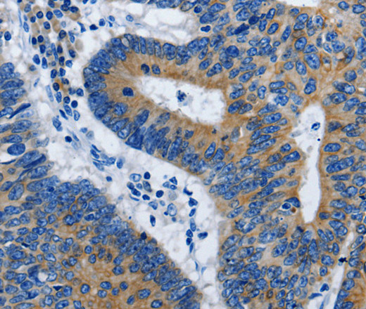 Immunohistochemistry of paraffin-embedded Human colon cancer using BPIFB3 Polyclonal Antibody at dilution of 1:50