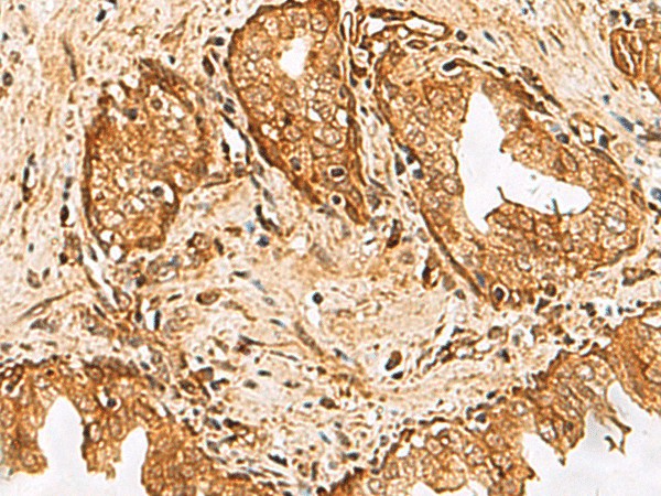 Immunohistochemistry of paraffin-embedded Human prost at e cancer tissue  using DHRS2 Polyclonal Antibody at dilution of 1:55(?200)