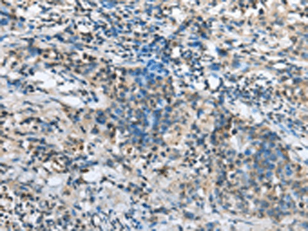 Immunohistochemistry of paraffin-embedded Human lung cancer tissue  using NDUFA12 Polyclonal Antibody at dilution of 1:30(?200)