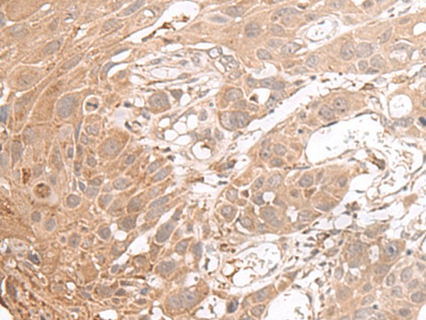 Immunohistochemistry of paraffin-embedded Human esophagus cancer tissue  using CHST4 Polyclonal Antibody at dilution of 1:35(?200)