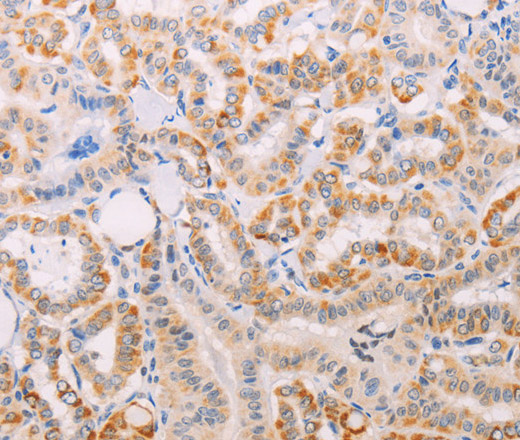 Immunohistochemistry of paraffin-embedded Human thyroid cancer tissue using MAP3K12 Polyclonal Antibody at dilution 1:30