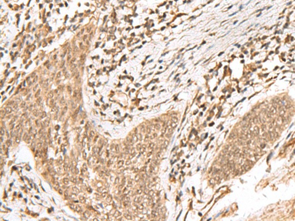 Immunohistochemistry of paraffin-embedded Human esophagus cancer tissue  using KDM2A Polyclonal Antibody at dilution of 1:55(?200)