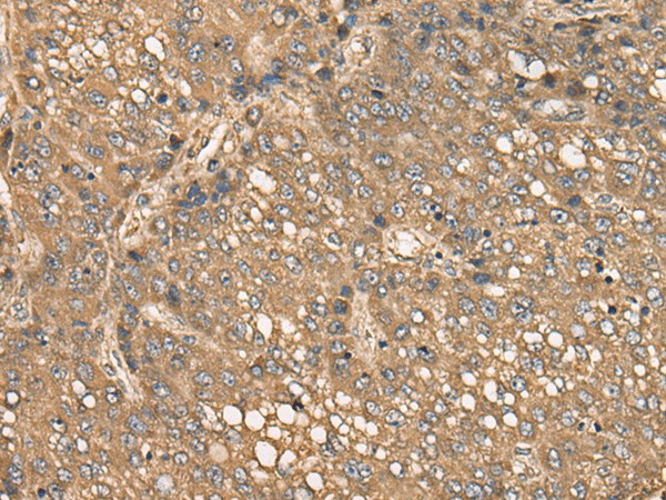 Immunohistochemistry of paraffin-embedded Human liver cancer tissue  using C4BPB Polyclonal Antibody at dilution of 1:35(?200)