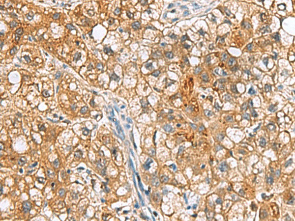 Immunohistochemistry of paraffin-embedded Human liver cancer tissue  using TTR Polyclonal Antibody at dilution of 1:50(?200)