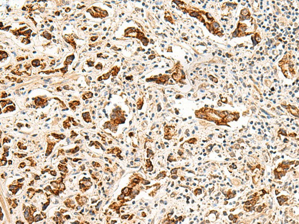 Immunohistochemistry of paraffin-embedded Human prost at e cancer tissue  using GPR160 Polyclonal Antibody at dilution of 1:35(?200)