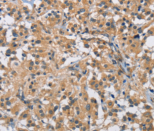 Immunohistochemistry of paraffin-embedded Human thyroid cancer using BMP15 Polyclonal Antibody at dilution of 1:40