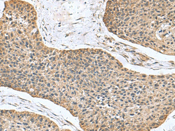 Immunohistochemistry of paraffin-embedded Human esophagus cancer tissue  using NFS1 Polyclonal Antibody at dilution of 1:100(?200)