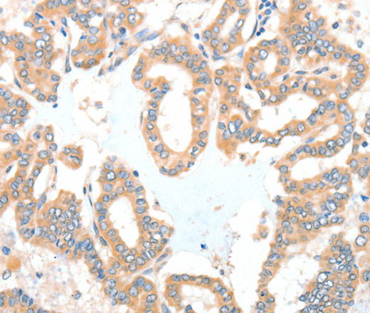 Immunohistochemistry of paraffin-embedded Human thyroid cancer tissue using ADCK1 Polyclonal Antibody at dilution 1:40