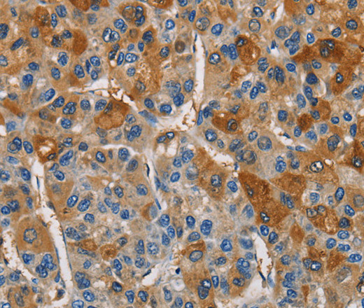 Immunohistochemistry of paraffin-embedded Human liver cancer tissue using CST4 Polyclonal Antibody at dilution 1:60