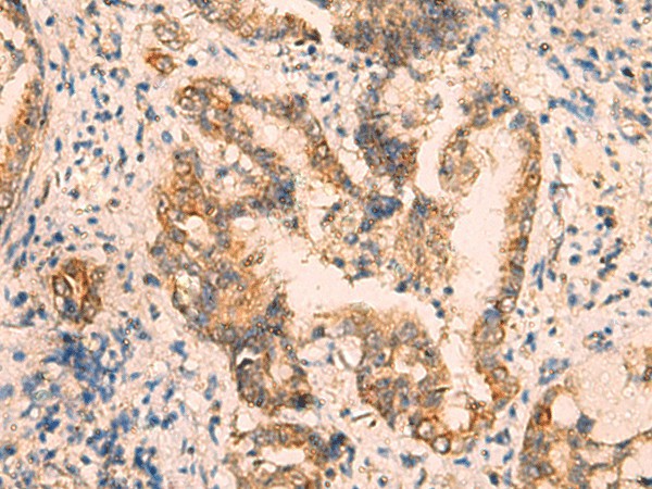 Immunohistochemistry of paraffin-embedded Human cervical cancer tissue  using CRYM Polyclonal Antibody at dilution of 1:65(?200)