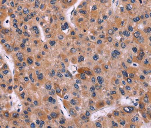 Immunohistochemistry of paraffin-embedded Human liver cancer tissue using CARD11 Polyclonal Antibody at dilution 1:40