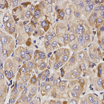 Immunohistochemistry of paraffin-embedded human liver cancer using GAS2 Polyclonal Antibody at dilution of 1:200 (40x lens).Perform microwave antigen retrieval with 10 mM PBS buffer pH 7.2 before commencing with IHC staining protocol.