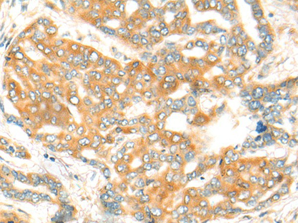 Immunohistochemistry of paraffin-embedded Human liver cancer tissue  using CFHR2 Polyclonal Antibody at dilution of 1:35(?200)