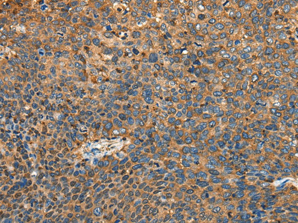 Immunohistochemistry of paraffin-embedded Human cervical cancer tissue  using MYL12B Polyclonal Antibody at dilution of 1:25(?200)