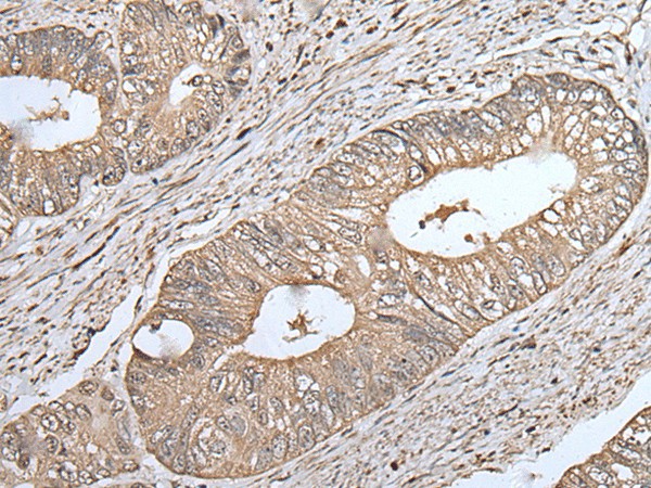 Immunohistochemistry of paraffin-embedded Human colorectal cancer tissue  using UQCRQ Polyclonal Antibody at dilution of 1:45(?200)