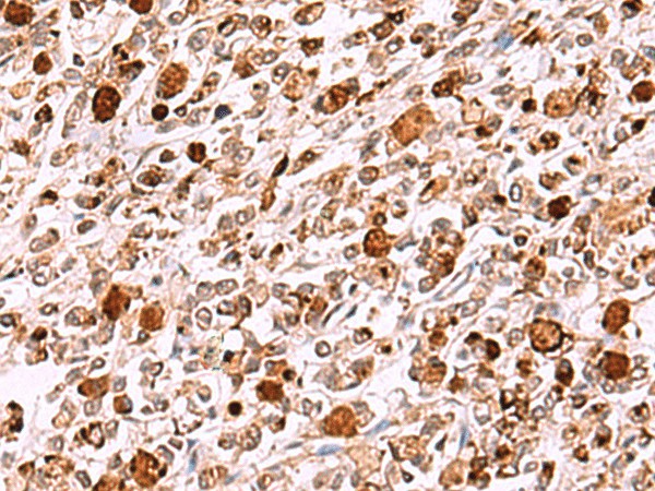 Immunohistochemistry of paraffin-embedded Human gastric cancer tissue  using INO80 Polyclonal Antibody at dilution of 1:85(?200)