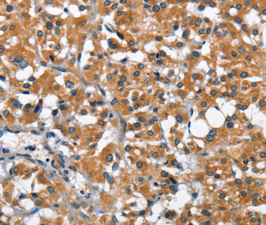 Immunohistochemistry of paraffin-embedded Human thyroid cancer using ARMCX2 Polyclonal Antibody at dilution of 1:40