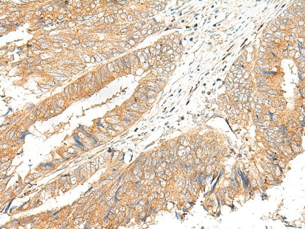 Immunohistochemistry of paraffin-embedded Human colorectal cancer tissue  using GPR151 Polyclonal Antibody at dilution of 1:45(?200)