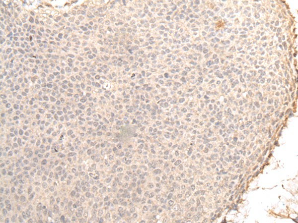 Immunohistochemistry of paraffin-embedded Human cervical cancer tissue  using ZNF263 Polyclonal Antibody at dilution of 1:30(?200)