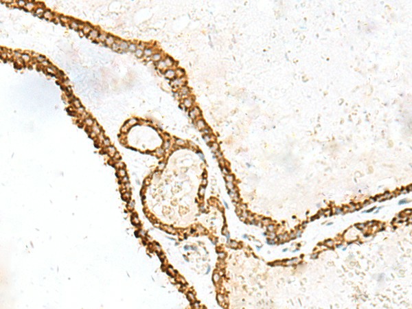 Immunohistochemistry of paraffin-embedded Human thyroid cancer tissue  using PDIA4 Polyclonal Antibody at dilution of 1:40(?200)