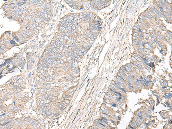 Immunohistochemistry of paraffin-embedded Human colorectal cancer tissue  using IGHA1 Polyclonal Antibody at dilution of 1:50(?200)