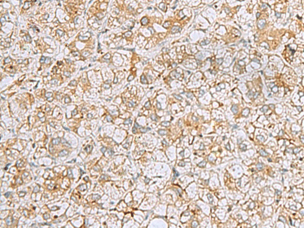 Immunohistochemistry of paraffin-embedded Human liver cancer tissue  using FERMT1 Polyclonal Antibody at dilution of 1:30(?200)