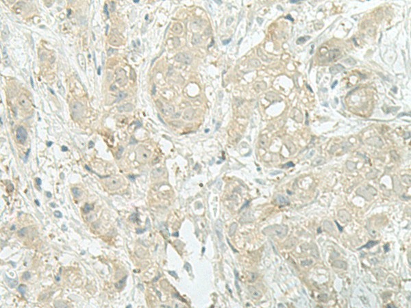 Immunohistochemistry of paraffin-embedded Human breast cancer tissue  using MIEN1 Polyclonal Antibody at dilution of 1:45(?200)