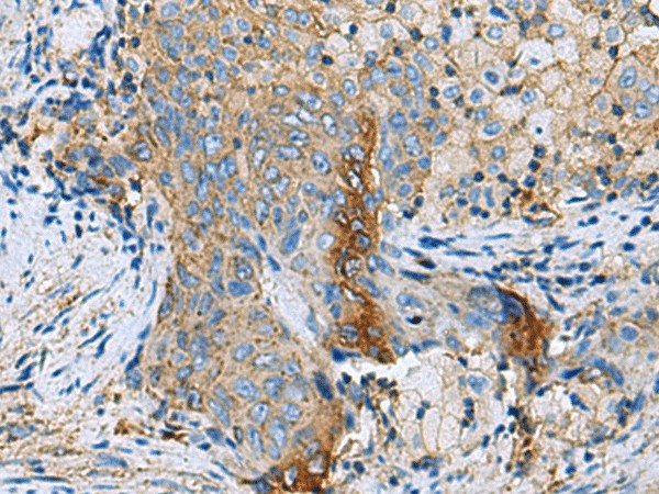 Immunohistochemistry of paraffin-embedded Human cervical cancer tissue  using CLTB Polyclonal Antibody at dilution of 1:70(?200)