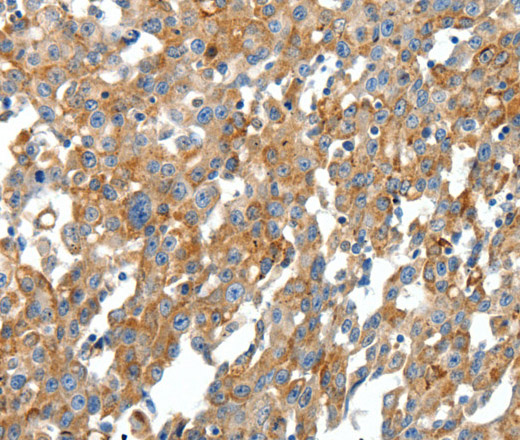 Immunohistochemistry of paraffin-embedded Human breast cancer tissue using CXCL12 Polyclonal Antibody at dilution 1:40