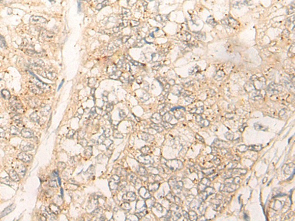 Immunohistochemistry of paraffin-embedded Human gastric cancer tissue  using CUTA Polyclonal Antibody at dilution of 1:40(?200)