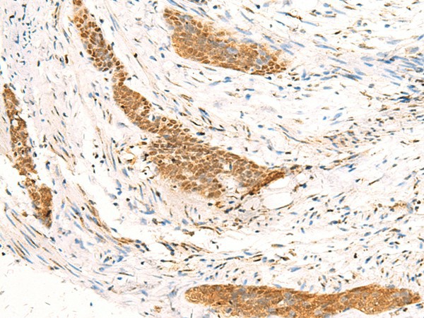 Immunohistochemistry of paraffin-embedded Human esophagus cancer tissue  using HTT Polyclonal Antibody at dilution of 1:30(?200)