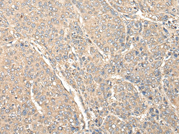 Immunohistochemistry of paraffin-embedded Human liver cancer tissue  using C1orf106 Polyclonal Antibody at dilution of 1:80(?200)