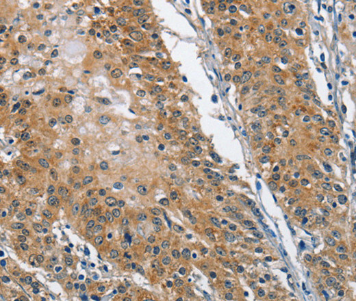 Immunohistochemistry of paraffin-embedded Human gastric cancer tissue using TRIP4 Polyclonal Antibody at dilution 1:40