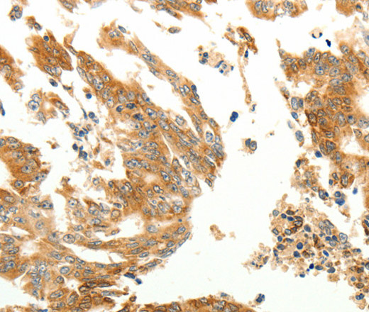 Immunohistochemistry of paraffin-embedded Human gastric cancer using RARRES1 Polyclonal Antibody at dilution of 1:60