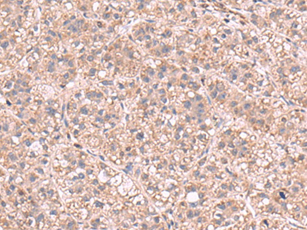 Immunohistochemistry of paraffin-embedded Human liver cancer tissue  using KPNA2 Polyclonal Antibody at dilution of 1:60(?200)