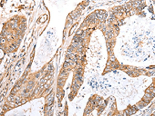 Immunohistochemistry of paraffin-embedded Human colorectal cancer tissue  using KCTD16 Polyclonal Antibody at dilution of 1:30(?200)