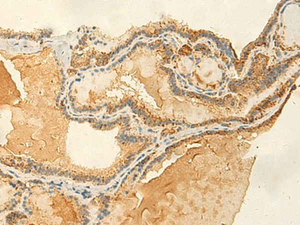 Immunohistochemistry of paraffin-embedded Human thyroid cancer tissue  using RNF148 Polyclonal Antibody at dilution of 1:50(?200)