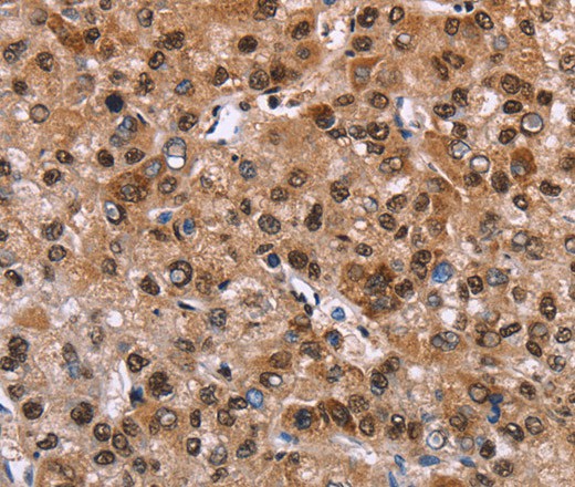 Immunohistochemistry of paraffin-embedded Human liver cancer tissue using GPR171 Polyclonal Antibody at dilution 1:40