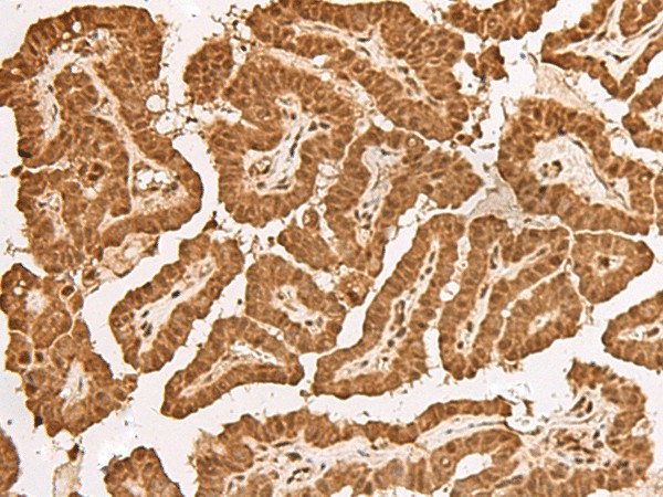 Immunohistochemistry of paraffin-embedded Human thyroid cancer tissue  using TIPRL Polyclonal Antibody at dilution of 1:65(?200)