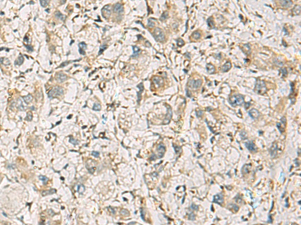 Immunohistochemistry of paraffin-embedded Human liver cancer tissue  using CMTM1 Polyclonal Antibody at dilution of 1:40(?200)