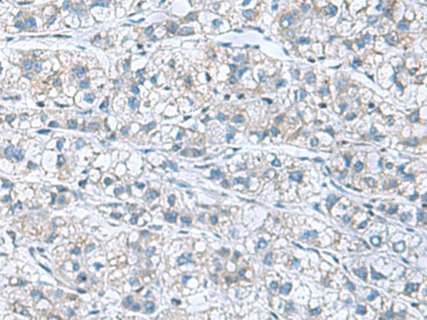 Immunohistochemistry of paraffin-embedded Human liver cancer tissue  using GDF9 Polyclonal Antibody at dilution of 1:55(?200)