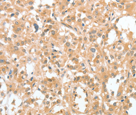 Immunohistochemistry of paraffin-embedded Human thyroid cancer using CIAPIN1 Polyclonal Antibody at dilution of 1:60