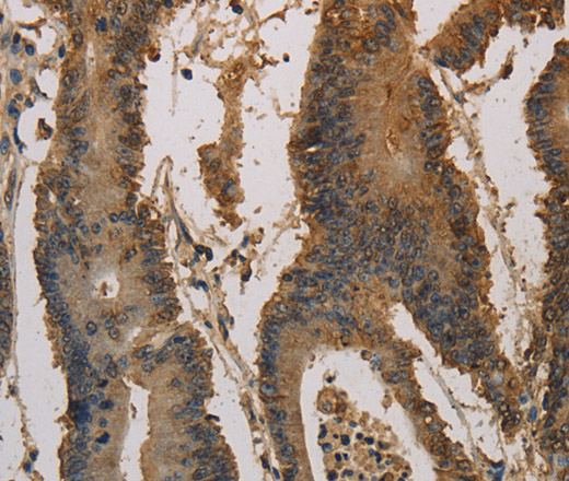 Immunohistochemistry of paraffin-embedded Human colon cancer using CK-16 Polyclonal Antibody at dilution of 1:30