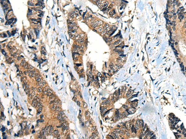 Immunohistochemistry of paraffin-embedded Human gastric cancer tissue  using BMPER Polyclonal Antibody at dilution of 1:40(?200)