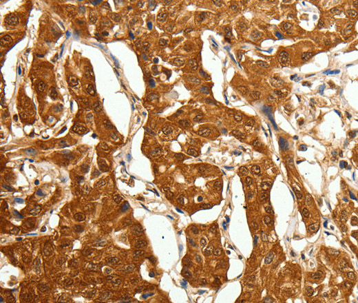 Immunohistochemistry of paraffin-embedded Human lung cancer using Otocadherin Polyclonal Antibody at dilution of 1:80