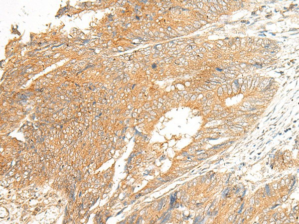 Immunohistochemistry of paraffin-embedded Human colorectal cancer tissue  using C5AR2 Polyclonal Antibody at dilution of 1:25(?200)