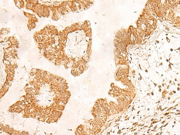 Immunohistochemistry of paraffin-embedded Human liver cancer tissue  using POLR1D Polyclonal Antibody at dilution of 1:50(?200)